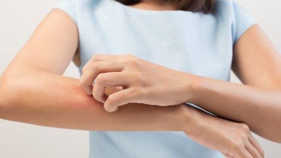 Cara Alami Mengatasi Biduran alias Kaligata saat Kambuh, 7 Obat Tradisional  Ini Solusinya - TribunNews.com