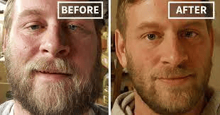 Before After Lepas dari Alkohol