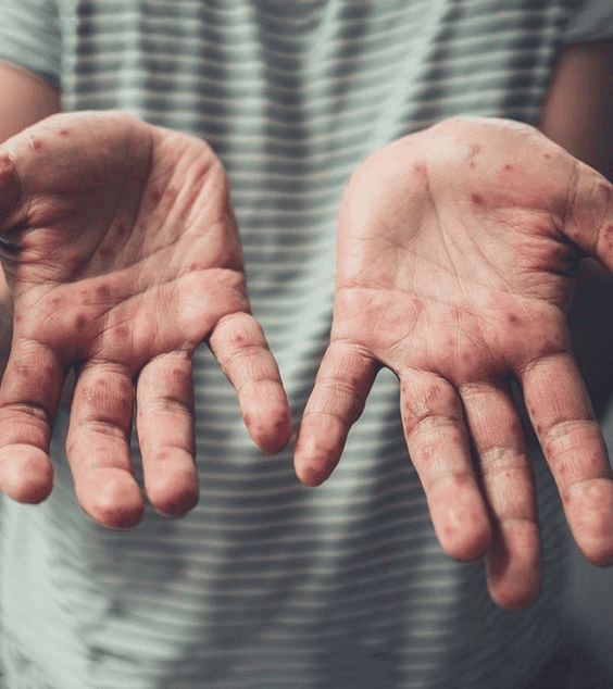 monkeypox