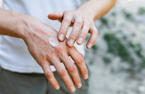 dermatitis atopik