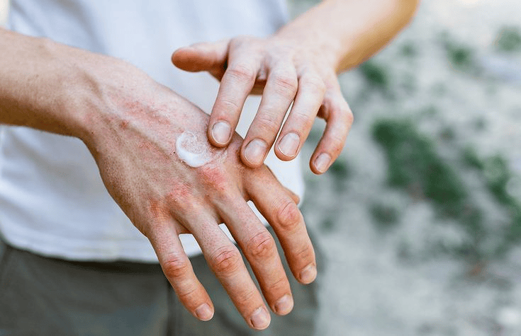 dermatitis atopik